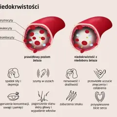 Niedokrwistość z niedoboru żelaza: porównanie poziomu żelaza, erytrocytów, leukocytów, trombocytów i objawów. Ferrytyna a żelazo.