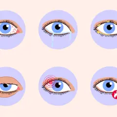 Sechs Augen zeigen verschiedene trockene Augen Symptome: Rötung, Tränen, Verkrustung, Schmerz, Brennen und ein müdes Auge.