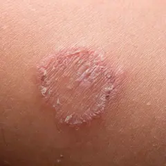 Macchie rosse sulla pelle, un'infezione fungina che forma un anello squamoso.