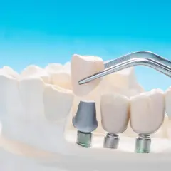 Un dente incapsulato viene posizionato con una pinzetta su un impianto dentale, parte di un modello di mascella.
