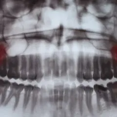 Kiedy rosną zęby mądrości? Objawy, ból i kiedy iść do dentysty