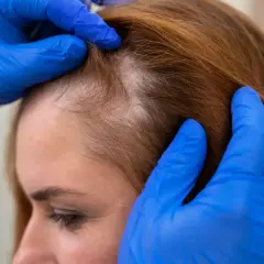 Manos enguantadas revisan el cuero cabelludo de una mujer, mostrando áreas de pérdida de cabello que podrían indicar un cuero cabelludo quemado.