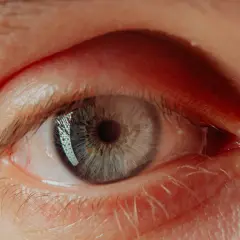 Närbild på ett öga med blågrå iris. En liten vit prick syns på ögonlocket, kanske en indikation på vagel behandling.