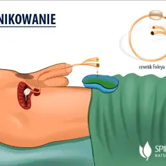 Po wyjęciu cewnika: objawy, zalecenia i kiedy iść do lekarza
