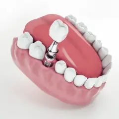 Un impianto dentale pronto per essere fissato, un passo verso il gusto della pizza dopo l'intervento.