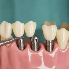 Model szczęki z implantami zębów i narzędziem. Sprawdź nasz cennik implantów zębów.