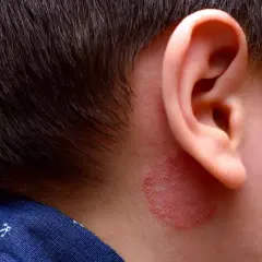 Arrossamento e desquamazione dietro l'orecchio di un bambino, simile a funghi.
