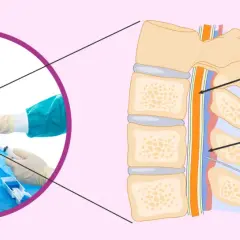 Ilustración de una inyección epidural. Una aguja se inserta en el espacio epidural de la columna vertebral. Puede haber dolor epidural meses después.