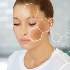 Kobieta z przebarwieniami na twarzy, nad którymi widnieje wzór chemiczny hydrochinonu.