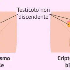 Illustrazione medica che mostra il criptorchidismo, una condizione in cui un testicolo non è sceso. Il testicolo ritenuto bambino 10 anni può essere unilaterale o bilaterale.