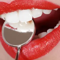 Labios rojos brillantes y dientes blancos examinados con un espejo dental. Averiguar cuanto se tarda en hacer un empaste pequeño es rápido.