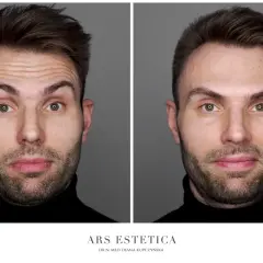 Przed i po zabiegu botoxu. Widoczne wygładzenie zmarszczek na czole, dzięki precyzyjnym botox miejsca wstrzyknięć.