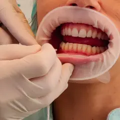 Mani guantate usano scovolini denti per pulire tra i denti di una persona con un divaricatore orale.