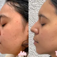 Comparativa de piel con acné y marcas. El lado "antes" muestra imperfecciones, mientras que el "después" revela una piel más lisa tras usar vitaminas para la cara.