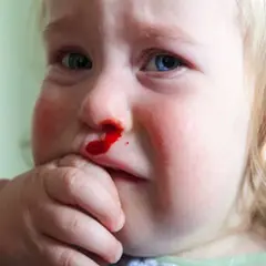 Małe dziecko z krwawieniem z nosa. Krwawienie z nosa u dziecka jest widoczne na jego twarzy.