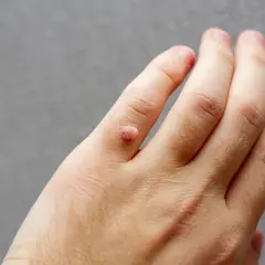 Närbild på en hand med en vårtliknande utväxt på ett finger. Det ser ut som att man vill dra ut vårta.