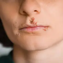 Bocche con lesioni tipiche di stomatite erpetica, con vescicole e croste sulle labbra e intorno alla bocca.