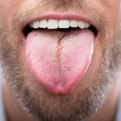 Primer plano de la boca de un hombre con barba, mostrando su lengua rosada con una **lengua blanca al final** y una grieta central.