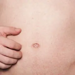 Ein Mann kratzt sich am Bauch, wo ein roter Ausschlag mit vielen kleinen Punkten zu sehen ist.