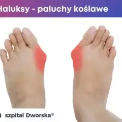 Ile kosztuje operacja haluksów? Cennik NFZ vs. Prywatnie 2025