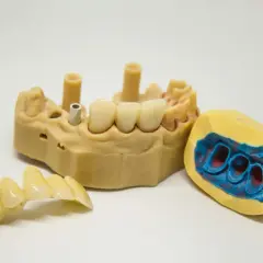 Model szczęki z implantami i mostkiem. Obok model wyciskowy szczęki. Proteza szkieletowa bezklamrowa w przygotowaniu.