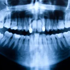 Radiografía panorámica dental que muestra una anomalía ósea, posiblemente un quiste en la boca, afectando la mandíbula inferior.