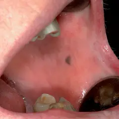 Una macchia scura sul palato, visibile vicino ai denti e a uno specchietto dentale.