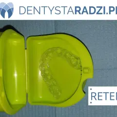 Cena nakładki retencyjnej po aparacie: Ile kosztuje i którą wybrać?