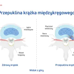 Porównanie zdrowego krążka międzykręgowego i krążka z wypukliną uciskającą nerw rdzeniowy. Widok z góry.
