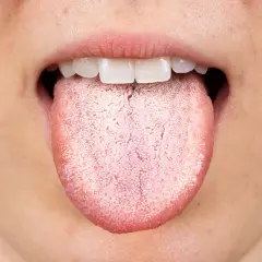 Lingua bianca e ruvida, possibile effetto collaterale di un antibiotico.