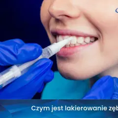 Profesjonalne lakierowanie zębów u dorosłych. Dentysta aplikuje środek wybielający na zęby pacjentki.
