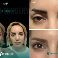 Przed i po laserowej korekcie powiek. Widoczne zmiany w wyglądzie oczu, poprawa opadających powiek.