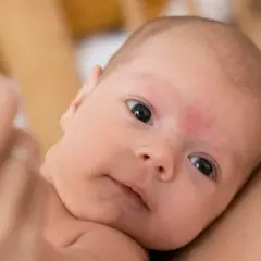 Primo piano di un neonato con pelle screpolata, tenuto in braccio.