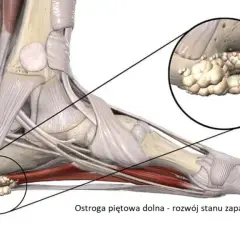 Ostroga piętowa: do jakiego lekarza i jak leczyć?