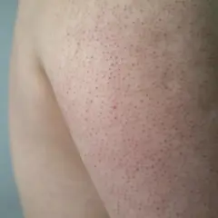 Närbild på en arm med keratosis pilaris hos ett barn. Små röda prickar syns över huden.