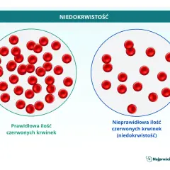 Porównanie prawidłowej i nieprawidłowej ilości czerwonych krwinek, czyli elementów morfotycznych krwi, w kontekście niedokrwistości.