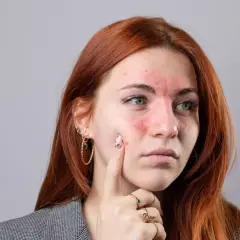 Czerwona wysypka na twarzy młodej kobiety, przypominająca objawy tocznia. Czy toczeń ile się żyje?