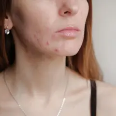 Primer plano de una mujer con granos y marcas de acné en la cara y el cuello.