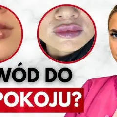 Jak zlikwidować siniaki po kwasie hialuronowym? Szybkie triki!