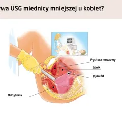 Ilustracja przedstawia badanie usg transwaginalne, pokazując narządy miednicy mniejszej: pęcherz moczowy, jajnik, jajowód i odbytnicę.