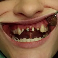 Usta z widocznymi zębami, niektóre wymagają leczenia. Widać fragmenty narzędzi dentystycznych. Planowana jest korona porcelanowa.