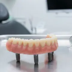 Proteza na implantach, gotowa do montażu. Nowoczesne rozwiązanie dla pełnego uśmiechu.