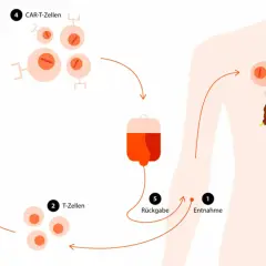Schema zur Immuntherapie: T-Zellen werden entnommen, modifiziert (CAR-T-Zellen) und zurückgegeben, um Krebszellen zu bekämpfen. So schnell wirkt Immuntherapie.