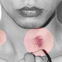 Primer plano de un cuello con dos moretones resaltados en círculos. La imagen sugiere la pregunta: cuanto tarda en irse un chupetón.