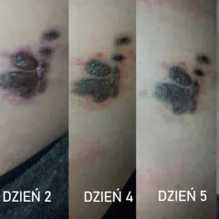 Postęp usuwania tatuażu łapy: od świeżej rany po gojenie. Dzień 2, 4, 5, 7.