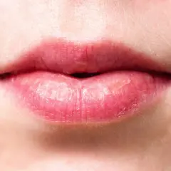 Labios agrietados y secos, con aspecto de labios quemados por el sol, muestran la necesidad de protección.