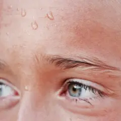 Gotas de sudor en la frente de una persona, un síntoma común de hiperhidrosis facial.