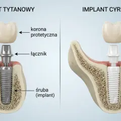 Porównanie rodzajów implantów zębowych: tytanowego i cyrkonowego, z widocznymi elementami: śrubą, łącznikiem i koroną protetyczną.