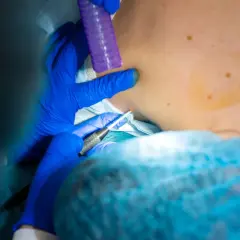 Chirurg w niebieskich rękawiczkach wykonuje biopsję skóry, pobierając próbkę do dalszych badań.