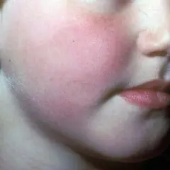 Barnets kind visar tydlig rodnad på huden, kanske efter lek utomhus.